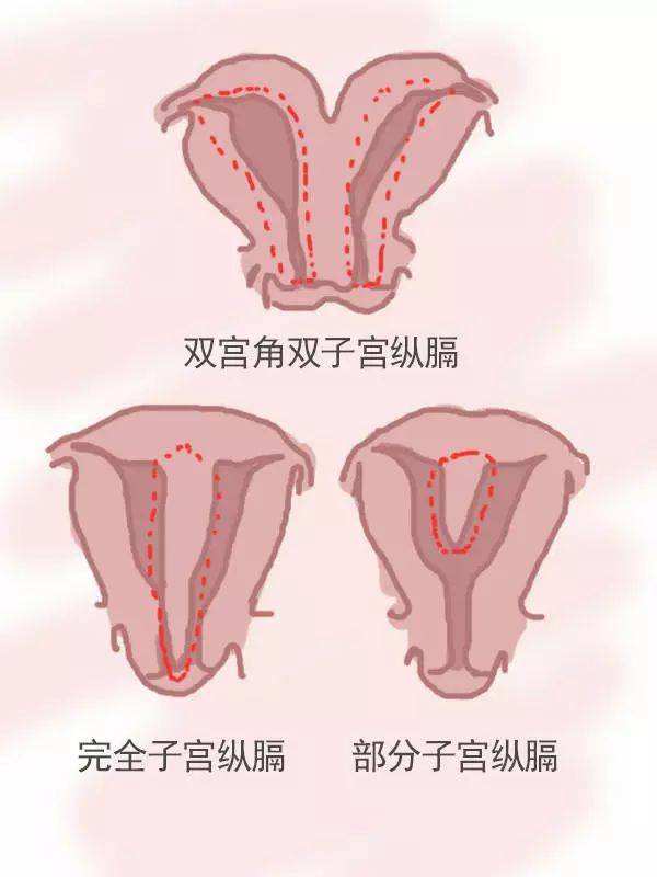 子宮畸形不完全縱膈怎么確診？