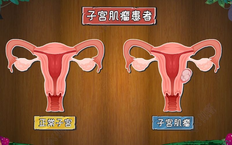 子宮肌瘤多大算嚴重，超過5厘米是很嚴重了嗎