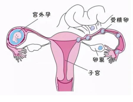 輸卵管通不通怎么檢查出來 一側不通能懷孕嗎