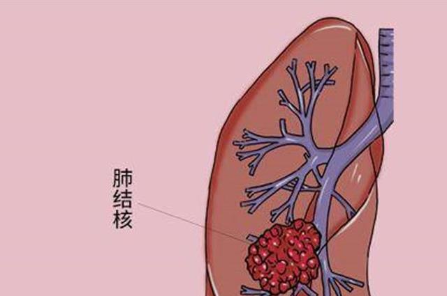 脖子出汗警惕四種病，你可要長點心了