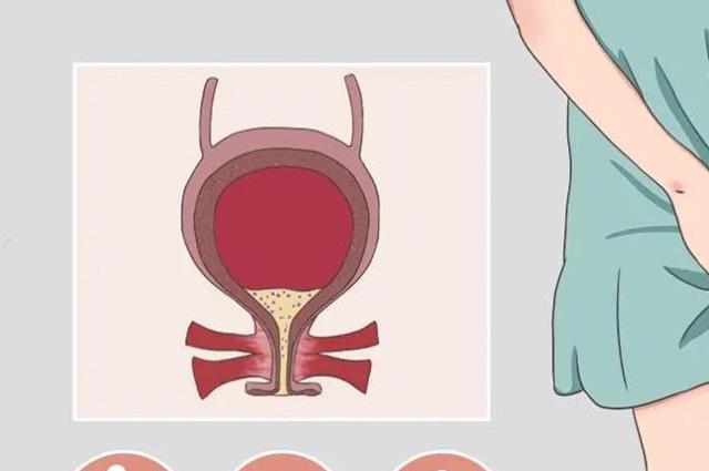 膀胱發(fā)炎有什么癥狀表現(xiàn)？這六點表現(xiàn)不容忽視