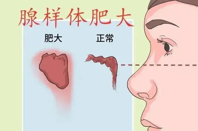 小孩腺樣體肥大是怎么引起的？常見誘發(fā)因素有這四個