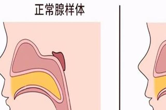 小孩腺樣體肥大是怎么引起的？常見誘發(fā)因素有這四個