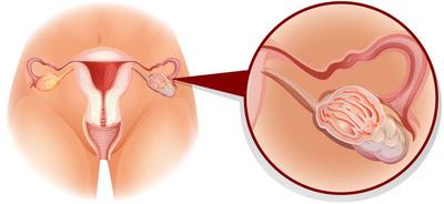 重慶醫院卵巢囊腫能吃大豆異黃酮嗎